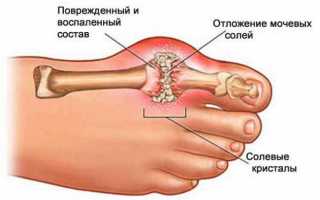 Общая характеристика подагры: симптомы, причины, осложнения