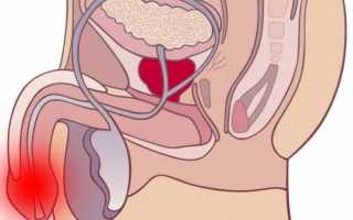 Рези и жжение в головке при мочеиспускании у мужчин