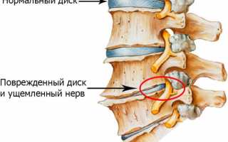 Как обнаружить защемление нерва в поясничном отделе?