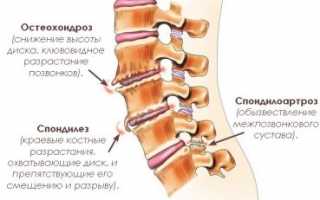 Как выявить деформирующий шейный спондилез?
