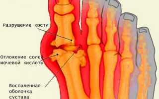 Как лечить подагру в период обострения?