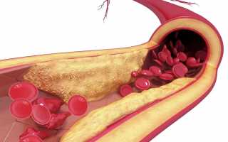 Как удалить холестериновые бляшки в сосудах