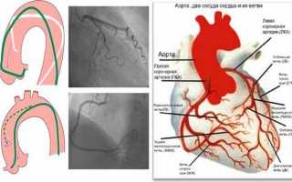 Как делают коронарографию сосудов сердца – подготовка, последствия