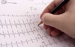 Может ли экг определить ишемическую болезнь сердца