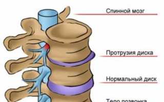 Как проявляется протрузия дисков позвоночника и как ее лечить