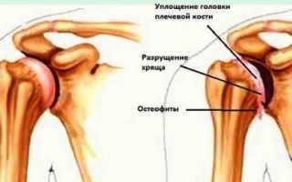 Симптомы и методы лечения хондроза плечевого сустава