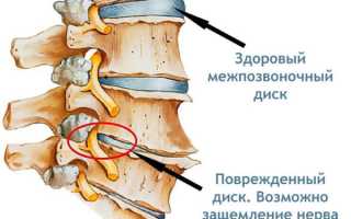 Как вылечить поясничный радикулит?