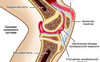 Что такое синовит и как его лечить?