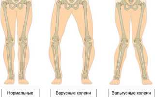 Что такое вальгусная деформация коленей у детей?