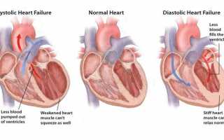 Какие симптомы приступа сердечной недостаточности