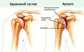 Помогает ли традиционная медицина в лечении артроза плечевого сустава?