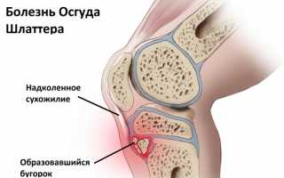 Как лечить недуг Шляттера коленного сустава?