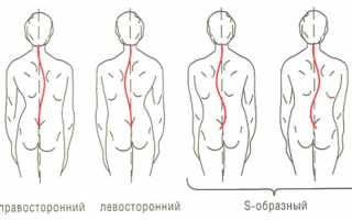 Берут ли на службу в армию при сколиозе 2 степени?