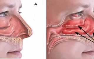 Что такое ринит: виды, причины и первые признаки
