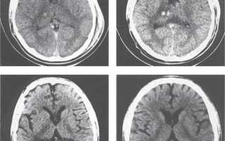 Легкие диффузные изменения бэа головного мозга: как понять и что делать