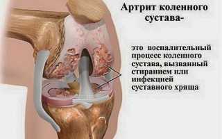 Воспаление суставов или артрит — как определить и победить недуг?