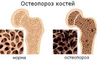 В чем особенность остеопороза костей и как бороться с недугом?