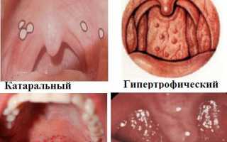 6 симптомов ларингита у детей, чем лечить