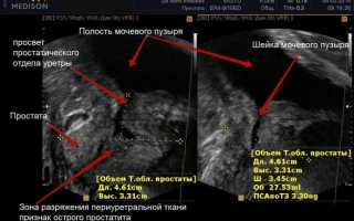Как проводится УЗИ предстательной железы – подготовка, расшифровка
