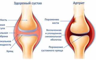 Воспаление в коленном суставе и его лечение