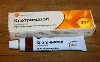 Симптомы себорейного дерматита в волосистой части головы и его лечение
