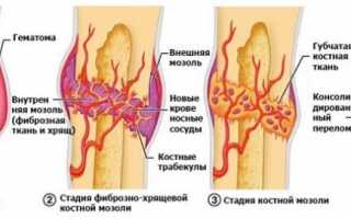 Костная мозоль после перелома – неизбежность и необходимость