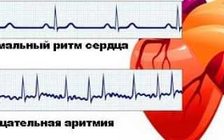 Причины аритмии сердца, симптомы и лечение