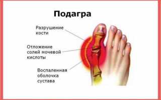 Что можно кушать при подагре?