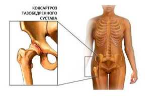 Можно ли вылечить коксартроз без хирургического вмешательства?