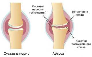 Что нужно знать о лечении такого заболевания, как артроз?