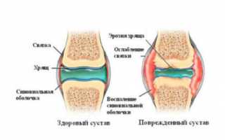Почему собирается суставная жидкость и как ее убрать?