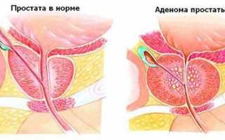 Как делают трУЗИ предстательной железы и как подготовится к процедуре