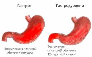 Гастродуоденит – 15 симптомов и лечение патологии