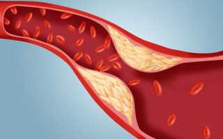 Как снизить холестерин в крови без использования статинов