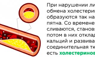 Холестериновые бляшки в сосудах как проверить