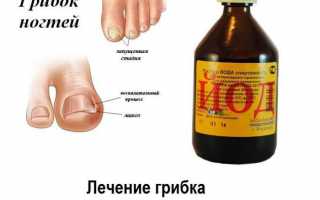 Йод для лечения грибка на ногтях