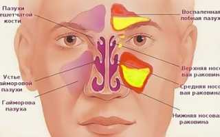 Лечение катарального гайморита