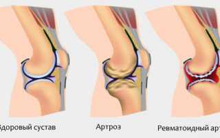 Особенности ревматоидного артрита и методы его лечения