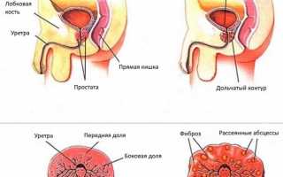 Хронический простатит – симптомы и лечение