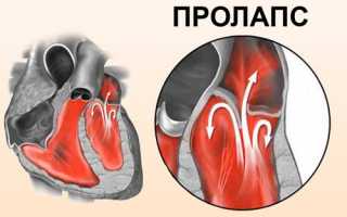 25 симптомов пролапса митрального клапана. Препараты для лечения