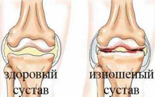 Лечение двухстороннего гонартроза разных степеней