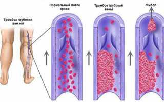 Признаки тромба в ногах симптомы и лечение