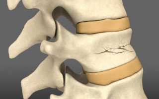 Компрессионные переломы позвоночника – симптомы, лечение и реабилитация