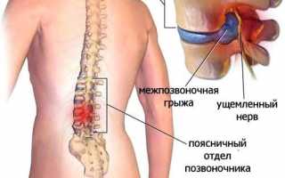 Радикулит поясничного отдела: симптомы и лечение