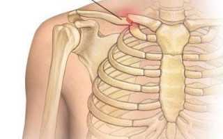 8 симптомов перелома ключицы, последствия