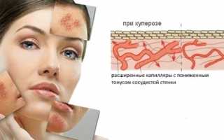 Формирование капилляров на носу и как их убрать?