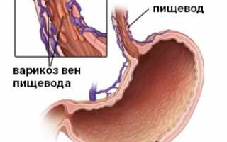 Варикозное расширение вен пищевода: симптомы и причины возникновения