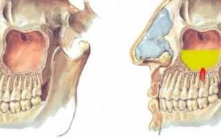 8 симптомов одонтогенного гайморита после удаления зуба. Как лечить