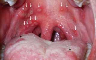 Герпесная ангина – как выглядит, симптомы и лечение