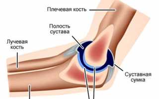 Что такое бурсит локтевого сустава и как его лечить?